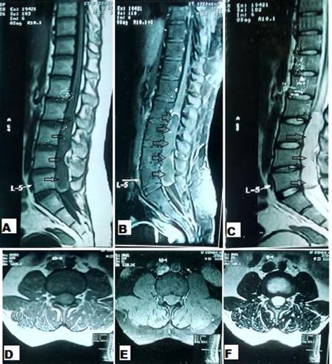 Figure 1 From Mature Cystic Teratoma Of Spinal Cord In An Adult