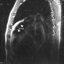 Axial T Weighted Black Blood Spin Echo Image Of Heart Mri In The