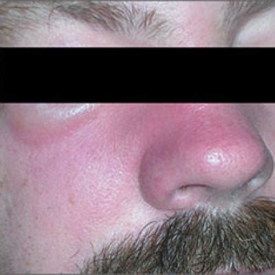 What Causes Swollen Nasal Passages