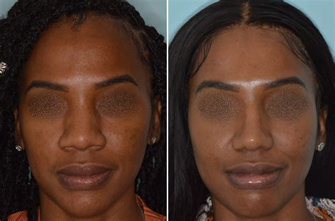 Ethnic Rhinoplasty Photos Miami Fl Patient 6454