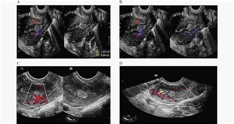 子宫内膜息肉在阴道超声影像下的误诊分析