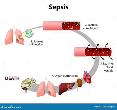 Sepsis Stock Vector Image 55481452