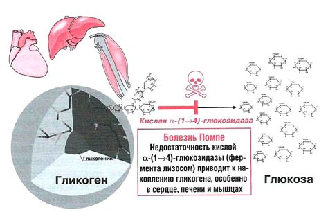 Болезнь Помпе | Справка.Неинвалид.ru