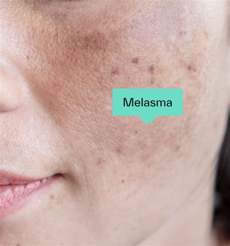 Melasma Treatments How To Treat Melasma Dermatica
