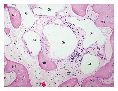 Histological Sections Of Bone Core Biopsy Harvested From The