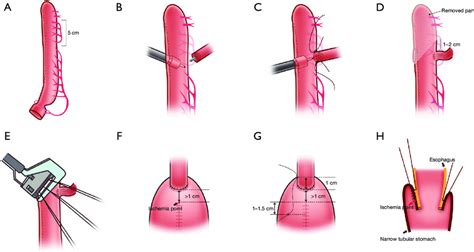 Scheme Of Pima A The Gastric Conduit Is Drawn To The Neck The