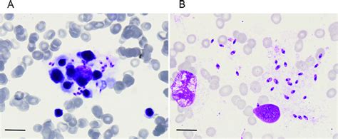 The Bone Marrow Biopsy Identified Hemophagocytosis And Leishmania