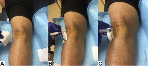 Intra Articular Corticosteroid Injection Following Total Knee