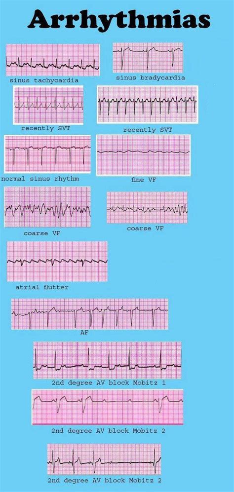 Ecg Interpretation Certification Online | TUTORE.ORG - Master of Documents