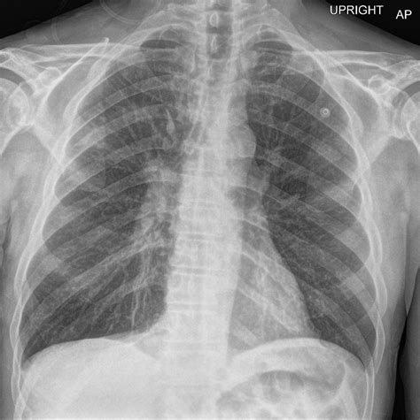 Chronic Bronchitis Chest X Ray Images At Gayla Wilson Blog