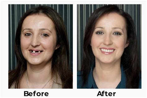 Teeth Implants in Turkey: Fill In The Blanks With The Best