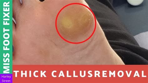 Thick Callus Removal Miss Foot Fixer Marion Yau Youtube