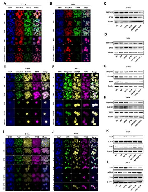 Propofol Augments Paclitaxel Induced Cervical Cancer Cell Ferroptosis