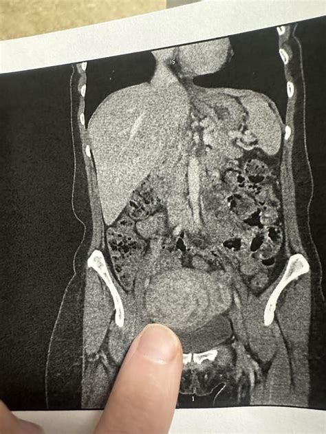 Abdominal Hysterectomy Vertical Incision Rhysterectomy