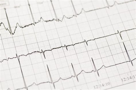 Using Practice Ekg Strips To Improve Your Ecg Interpretation