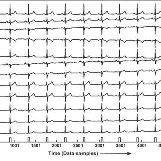 QRS detection in record no. 201 of MIT-BIH Arrhythmia database ...