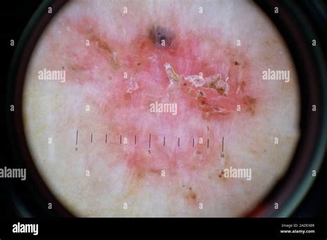 Modelo Liberado Carcinoma Basocelular Diagnóstico Mediante El Examen