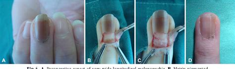 Tangential Excision Of Pigmented Nail Matrix Lesions