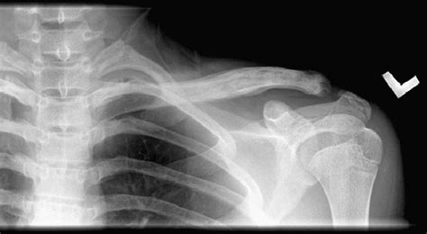 Left Clavicle X Ray