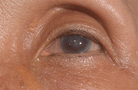 Corneal Edema Glaucoma