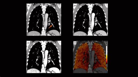 Metastatic Pulmonary Adenocarcinoma Complicated By Pe Siemens