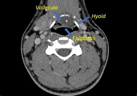 Vallecular Cyst In An Adult Patient Eurorad