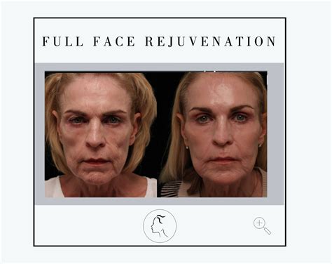 Facial Aesthetics Center | Filler Gallery