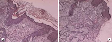 Epidermis Shows Hyperkeratosis With Follicular Plugging And