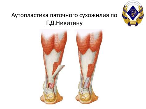 Ахиллово сухожилие - online presentation