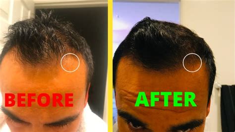 What are effective ways of treating early male pattern baldness? - Quora