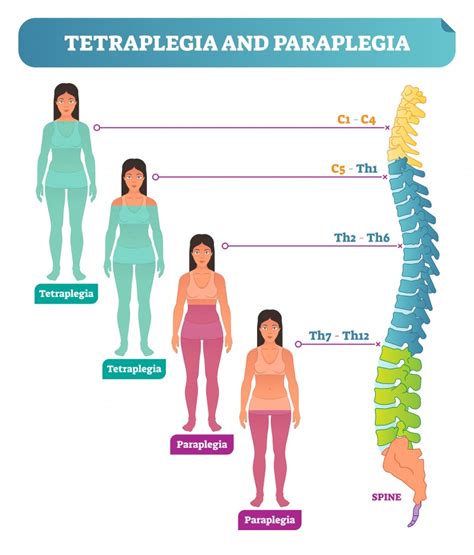 Lesiones Medulares Tipos