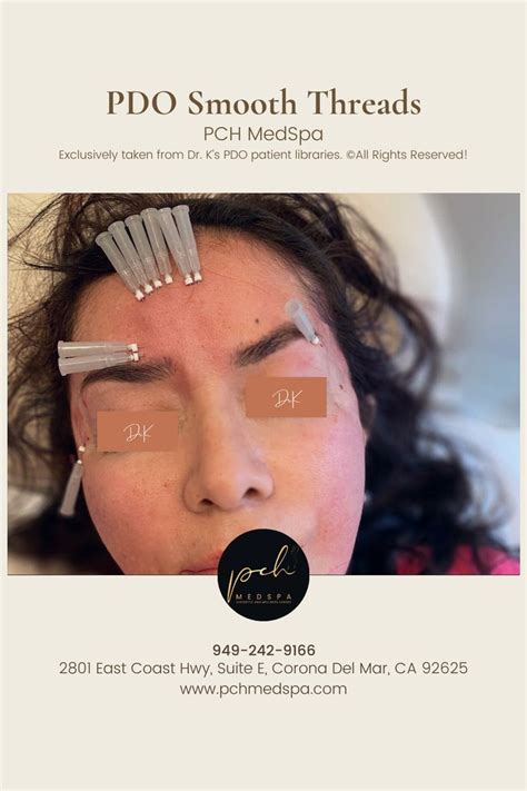 Pdo Thread Lift Non Surgical Facelift Thread Lift Aesthetic