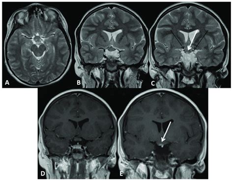 Optic glioma 1Aright (Subject 12 OPG). Orbit MRI. (A) Axial T2-weighted ...