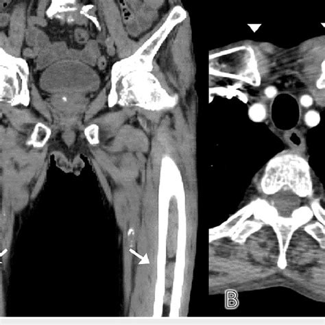 Contrast Enhanced Computed Tomography Of The Chest And Computed