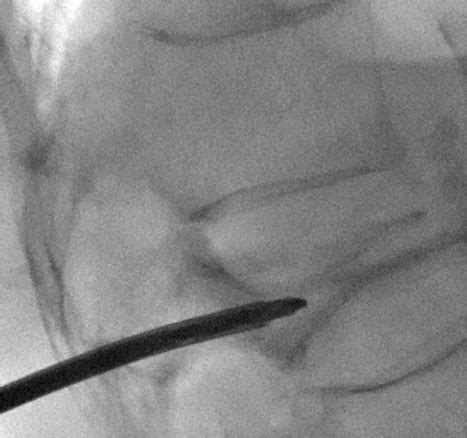 Kyphoplasty — IR Notes