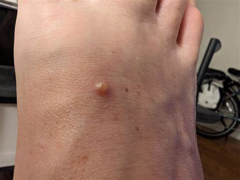 Help Identifying Bump On Foot Nudes Popping Nude Pics Org