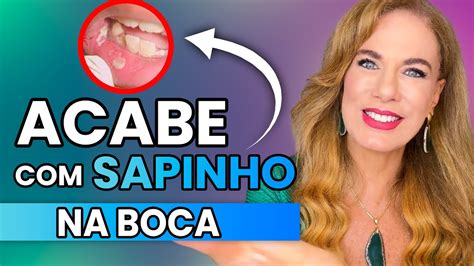 O Que E Bom Para Sapinha Na Boca - ACABE com a CANDIDIASE ORAL ou SAPINHO na BOCA com 3 DICAS NATURAIS ...