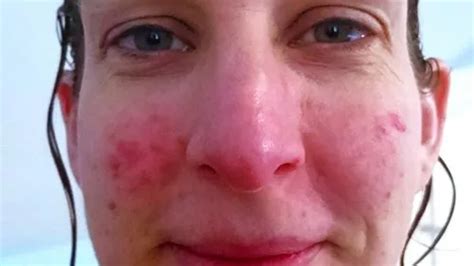 Woman S Face Erupted Into Red Hot Furnace Splashing Cold Water Made It Even Worse Mirror