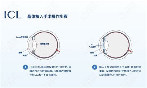 兰州近视眼手术价格表更新全飞秒激光15w普通激光6k其他术式费用都有最热整形行业新闻话题 美佳网