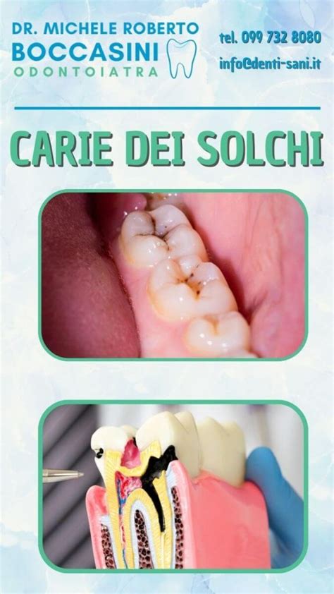 1 Prevenzione Delle Carie Dei Solchi Studio Boccasini