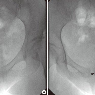 data   patients  symphysis pubis diastasis  delivery