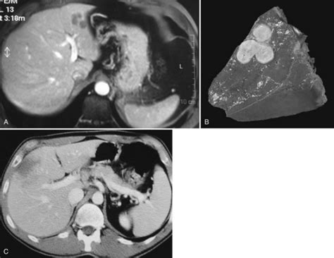 Benign Liver Lesions Abdominal Key