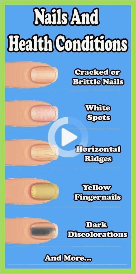 8 Important Signs Your Fingernails Can Tell About Your Health In 2021