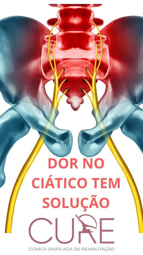 Ciatalgia a Dor no Nervo Ciático Clínica de Fisioterapia e Pilates