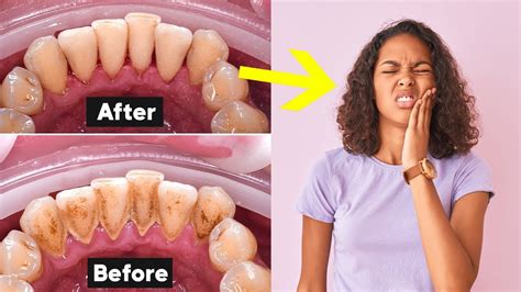 Deep Teeth Cleaning Recovery Tips How To Heal Fast Etoners