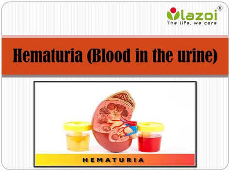 PPT - Hematuria (Blood in the urine): Symptoms, causes, diagnosis and