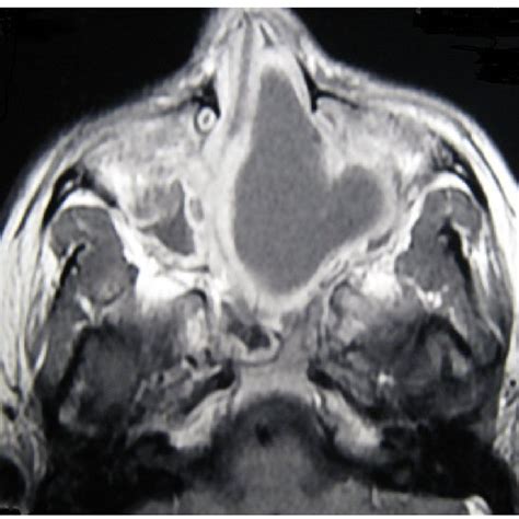 Axial Ct Scan Of The Paranasal Sinuses Showing A Mass In The Left Nasal