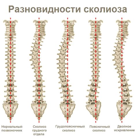 Лечение сколиоза в Израиле | Manor Medical Center