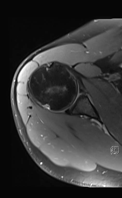 Radiopaedia case Hill-Sachs lesion with bony Bankart lesion id: 39873 study: 42339 - NC Commons