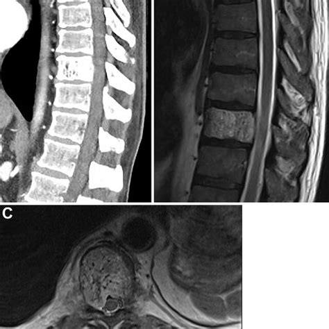 Sagittal Ct A Sagittal Mri B And Axial Mri C Showing A T10 Download Scientific Diagram